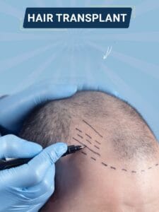 Hair Transplantation in Turkey