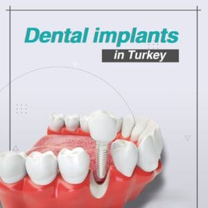 Dental Implants in Turkey