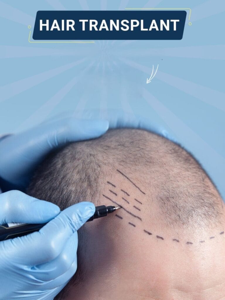 Experts Hair Transplant